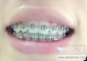 大牙图片,探寻独特牙齿之美