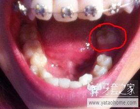 大牙图片,探寻独特牙齿之美